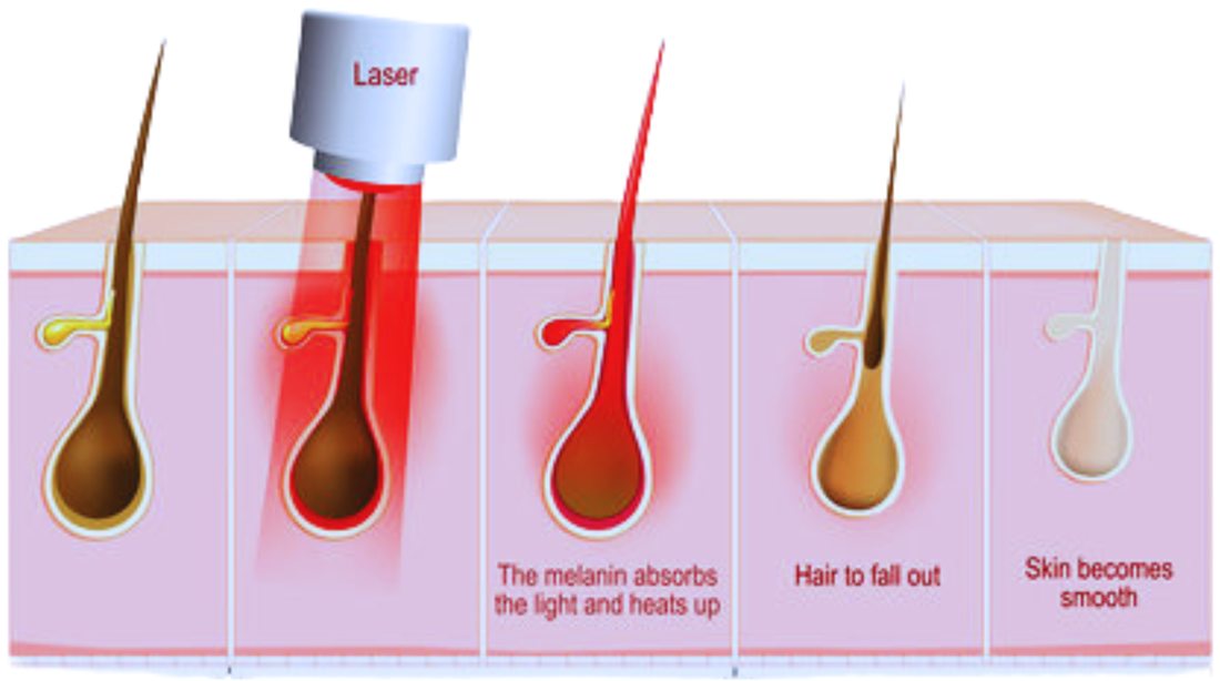 Laser hair removal for women