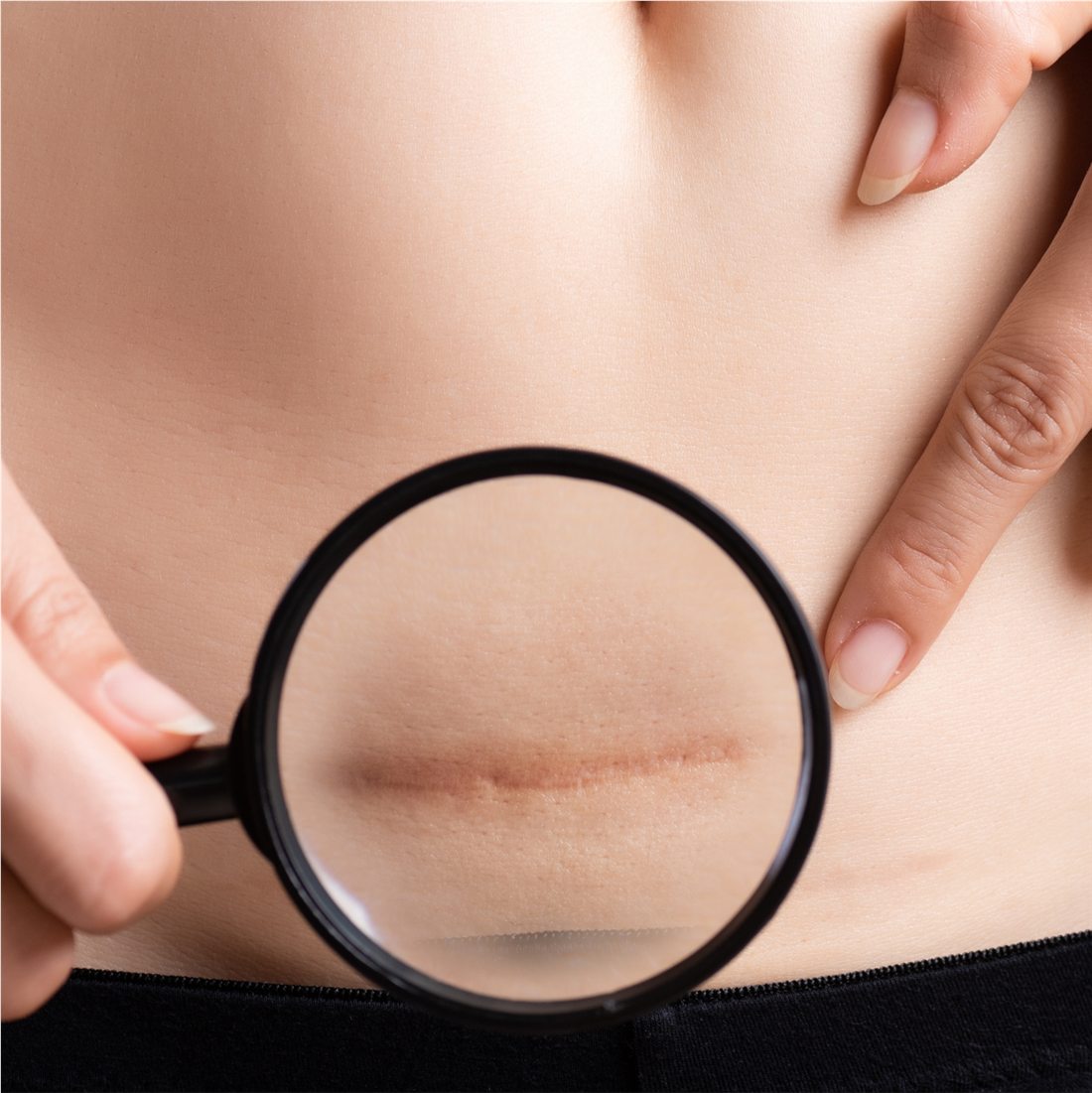 Scar camouflage permanent makeup