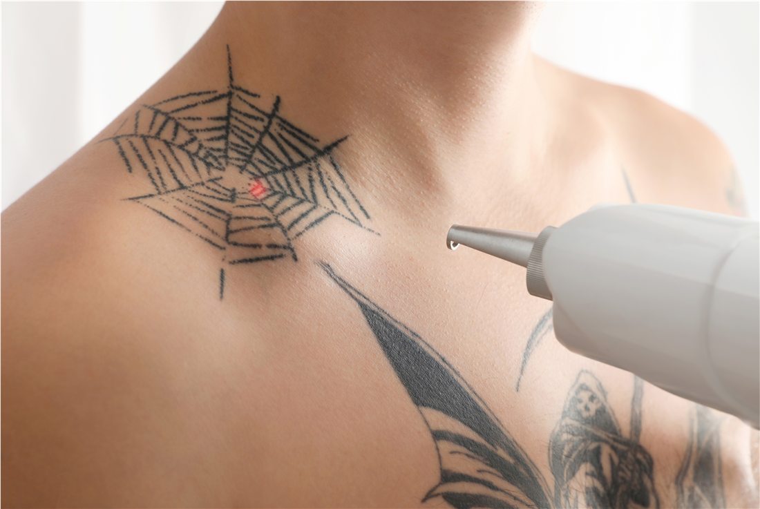 Tattoo removal result from Brow Esteline