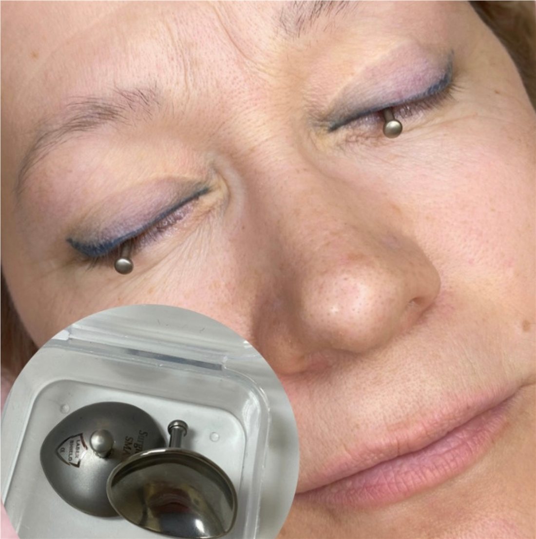 Eyeliner pigment removal result